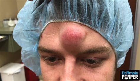 dr pimple popper tackles man s huge unicorn cyst in grotesquely satisfying video metro news