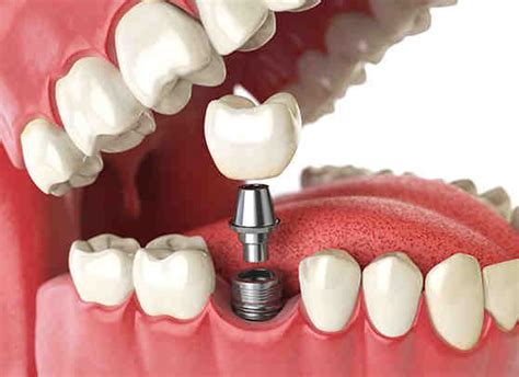 clean dental implants properly dental news network