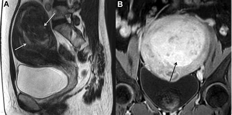 sagittal t2 weighted mri a shows the uterine fibroid with