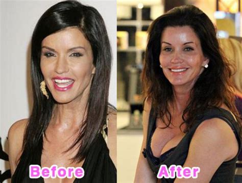 celebrity plastic surgery before and after photos 16 pics