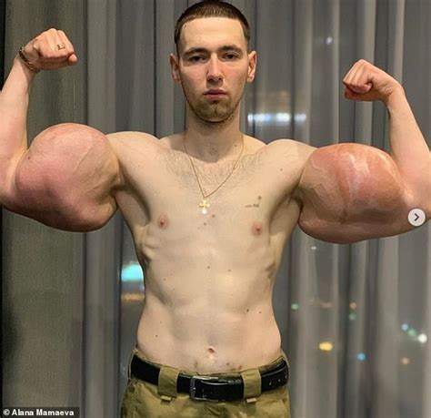 popeye bodybuilder has 3lb of dead muscle removed by surgeons daily