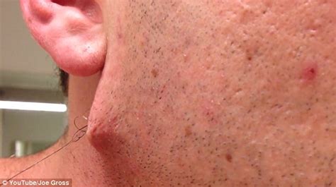 man pulls world s longest ingrown hair out of his face