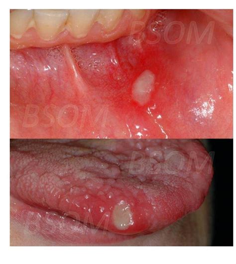 Recurrent Mouth Ulcers British And Irish Society For Oral