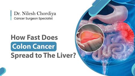 How Fast Does Colon Cancer Spread To The Liver