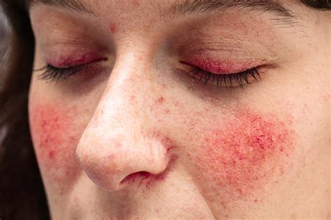 persistent red rash  cheeks doctor explains scary symptoms