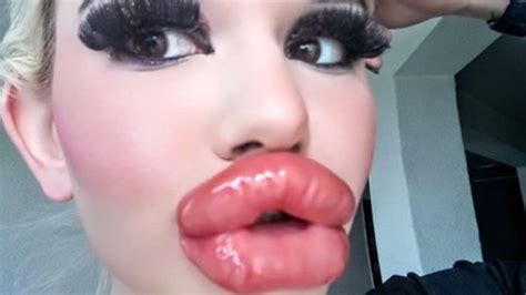 woman has 20 lip filler injections to have world s biggest lips photo