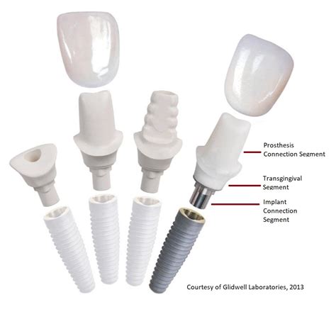 basics  implant abutments australasian restorative  implant