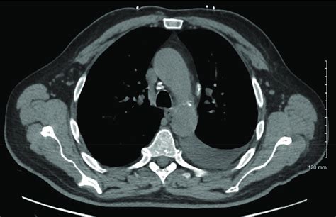 Calcified Hilar Lymph Nodes And A Large Left Sided Pleural Effusion
