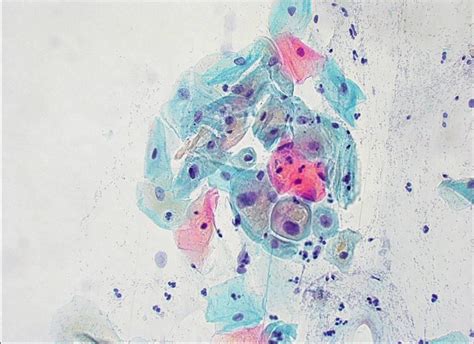 Atypical Squamous Epithelial Cells Of Uncertain Signficance Ascus