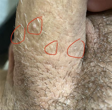 Odd Bump S Appeared Worried It’s Gw Penis Disorders Forums Patient