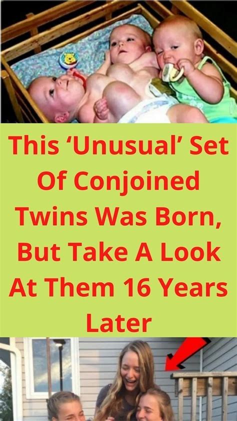 These 2 Months Old Conjoined Twins Share One Liver And I Had The Honor