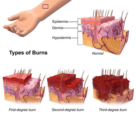 burns almostadoctor