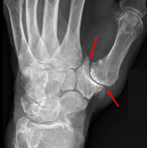 thumb arthritis raleigh hand surgery joseph  schreiber md