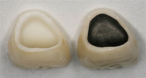 metal ceramic post core  crown  maxillary central incisor fororg