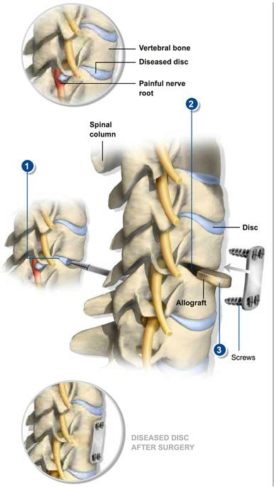 Anterior Cervical Discectomy And Fusion Southeastern Spine