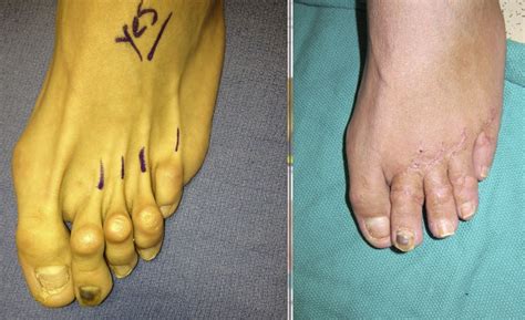 Best Hammertoe Surgeon In Nyc Before And After Pictures