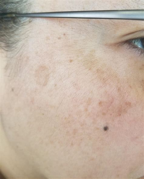 melasma liver spots sun damage rplusskincare
