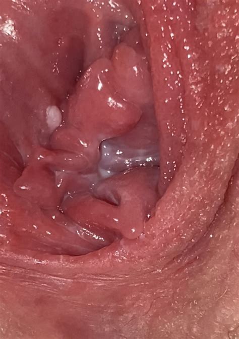 Help Found A Single White Bump Near Vaginal Opening
