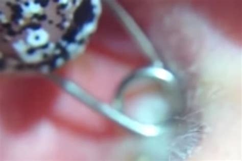 grim footage shows mr pimple removing cyst from inside man s ear