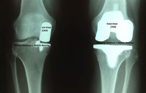 unicondylar partial knee replacement scottsdale joint center