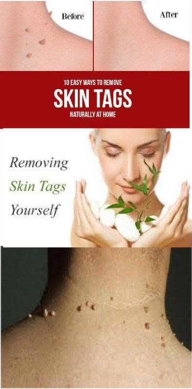 10 easy ways to remove skin tags naturally at home skin tag removal