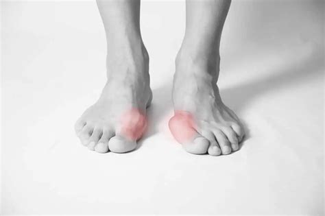 deformacija palca na stopalu uzrok simptomi lijecenje arzhr