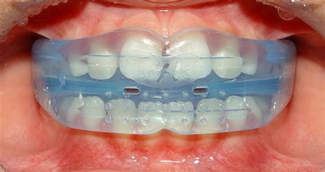 myobrace the natural approach to dental