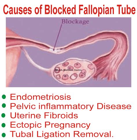 causes of blocked fallopian tube