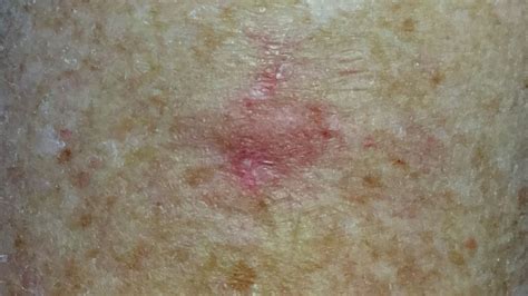 bowens disease spot check skin cancer aesthetics melbourne cbd