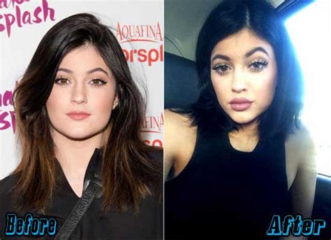 kylie jenner plastic surgery before and after plastic