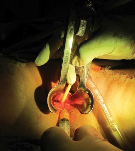 After Insertion Of A Speculum A Strict Submucosal Injection Of 8 Cc
