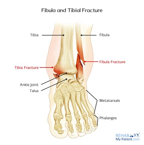 fibula  tibial fracture rehab  patient