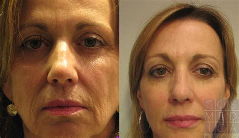botox® cosmetic before and after photos patient 39