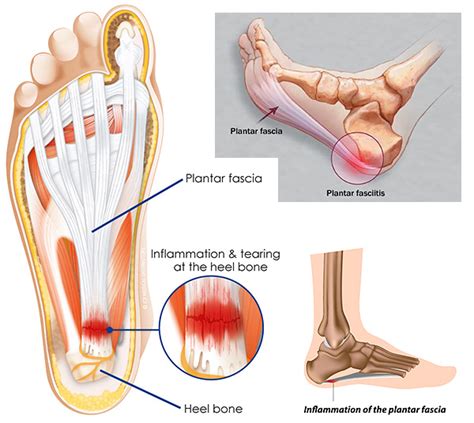 plantar fasciitis heel pain diversified integrated sports clinic