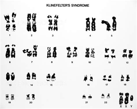 Photograph Klinefelter S Syndrome Karyotype Science Source Images