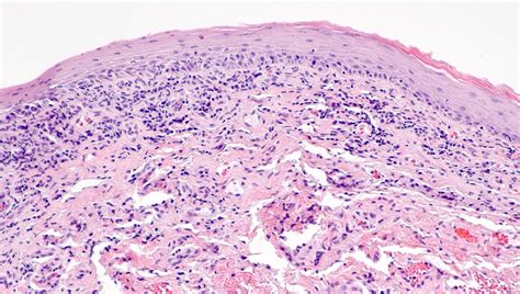 pathology outlines lichen sclerosus