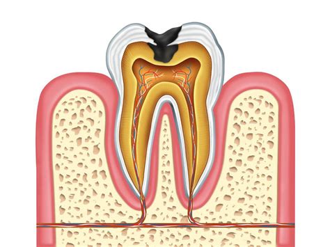cavities foundation  alternative