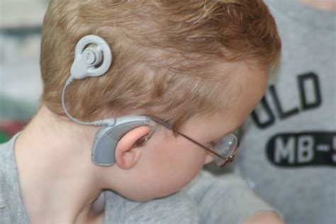 Fda Approves A Remote Feature To Cochlear Implant System With Images