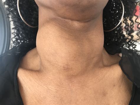 thyroid nodules  goiters   surgery  benign goiter nodules thyroid center  santa