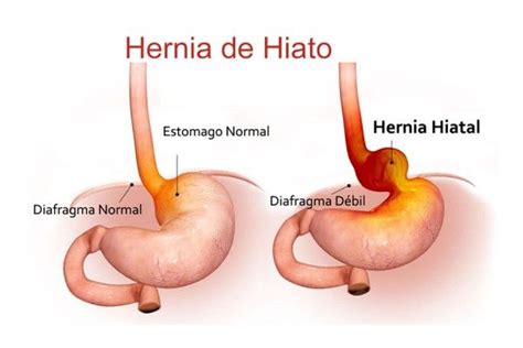 ¿es normal tener “ardores” de estómago hernia de hiato urgencias médicas sevilla