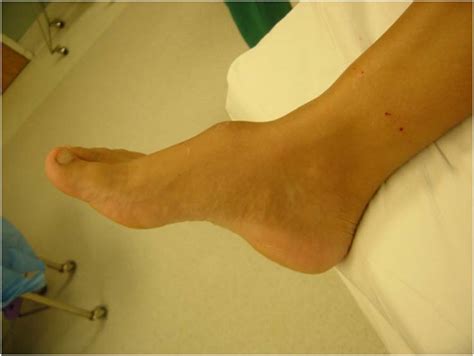 Smooth Muscle Cell Tumor The Foot And Ankle Online Journal