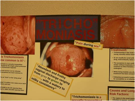 Trichomoniasis The Sti You May Not Have Heard Of Super Smart