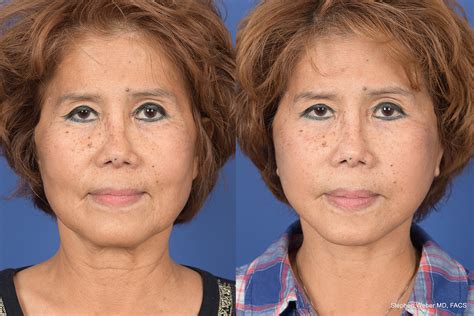 Facelift Before And After 52 Weber Facial Plastic Surgery