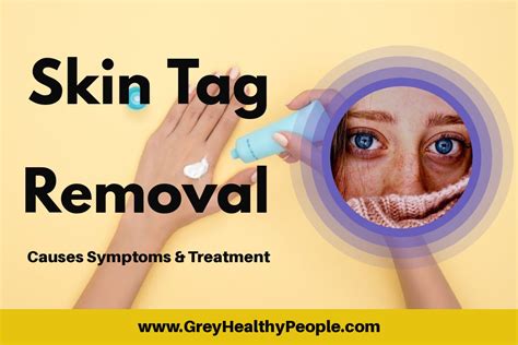 skin tag removal causes symptoms treatment