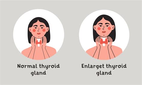 normal  enlarget thyroid gland woman showing thyroid gland