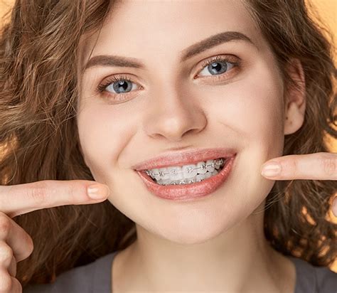 traditional braces marion  orthodontics bruner dental