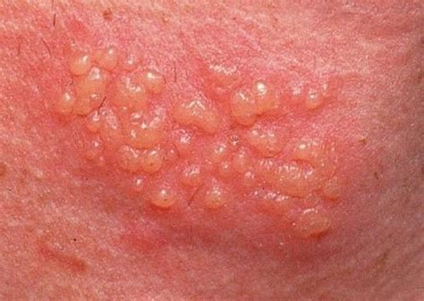 genital herpes symptoms causes and treatment