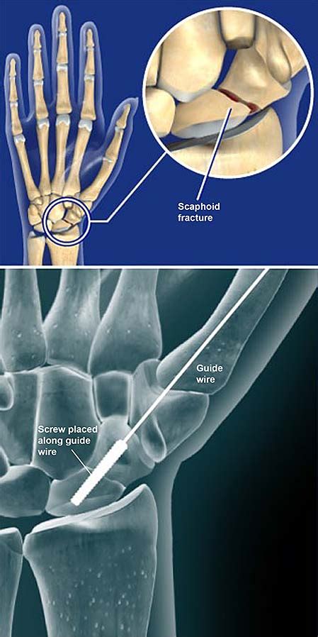 scaphoid fracture open reduction  internal fixation orif central