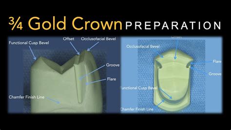 gold crown preparation maxillary premolar youtube
