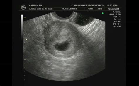 first ultrasound 4 6 weeks primer ultrasonido 4 6 semanas youtube